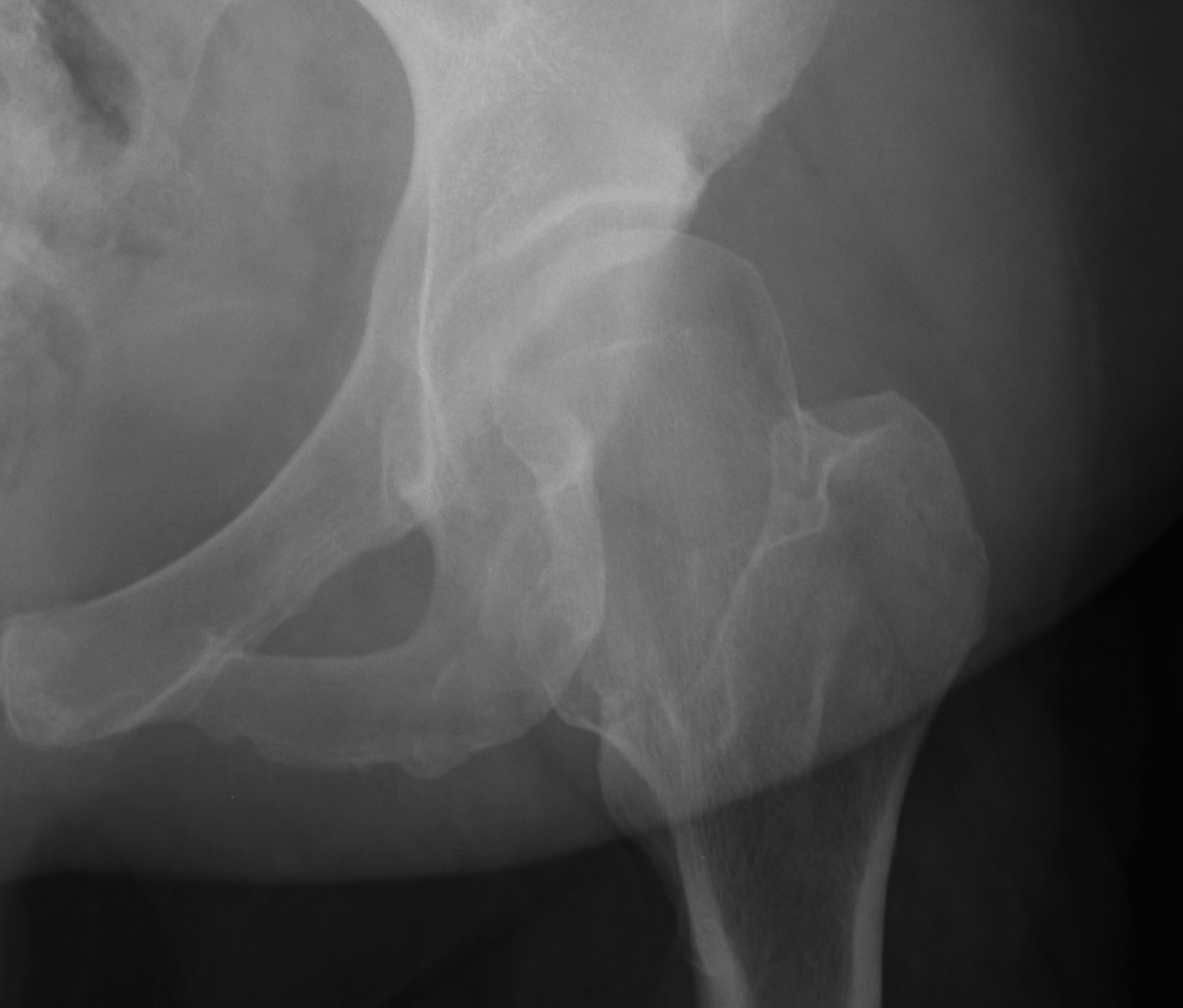 Lateral Subluxation Hip